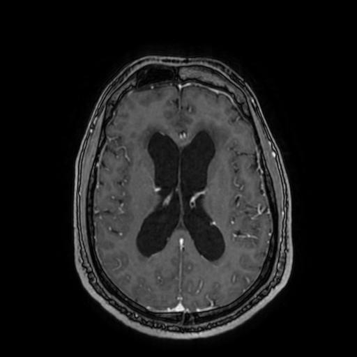 Cerebellar hemangioblastoma (Radiopaedia 88055-104622 Axial T1 C+ 106).jpg