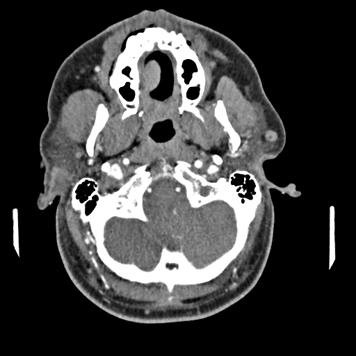 Cerebellar infarct due to vertebral artery dissection with posterior fossa decompression (Radiopaedia 82779-97029 C 44).png