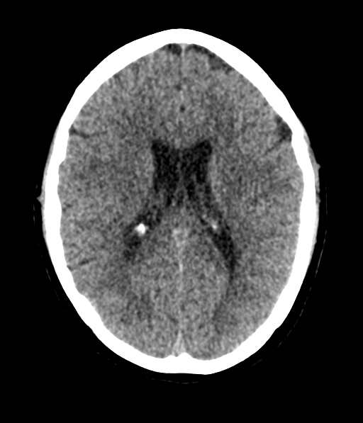 File:Cerebellar metastases - colorectal adenocarcinoma (Radiopaedia 40947-43652 Axial non-contrast 38).png