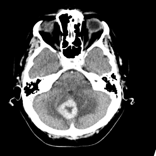 Cerebellar metastasis (Radiopaedia 54578-60812 Axial C+ 13).png