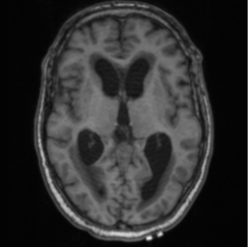 Cerebellar metastasis from lung adenocarcinoma (Radiopaedia 86690-102829 Axial T1 42).png