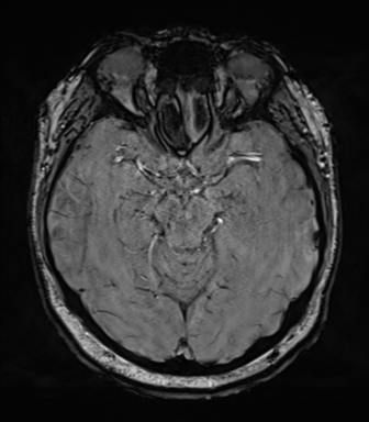 Cerebellopontine angle meningioma (Radiopaedia 48434-53348 Axial SWI 37).png