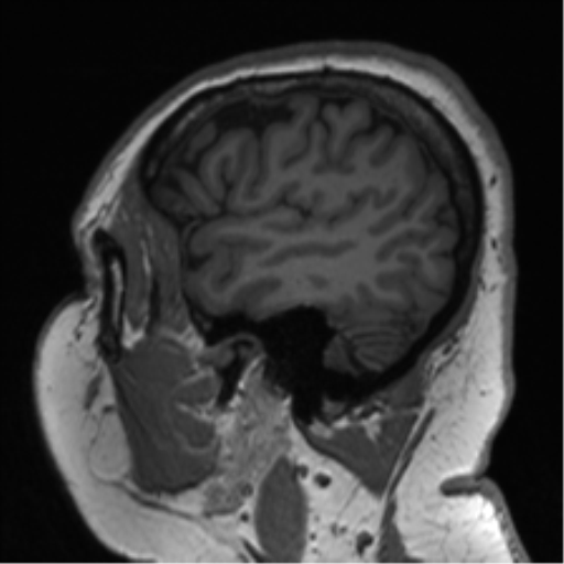 File:Cerebellopontine angle meningioma (Radiopaedia 48434-53348 Sagittal T1 20).png