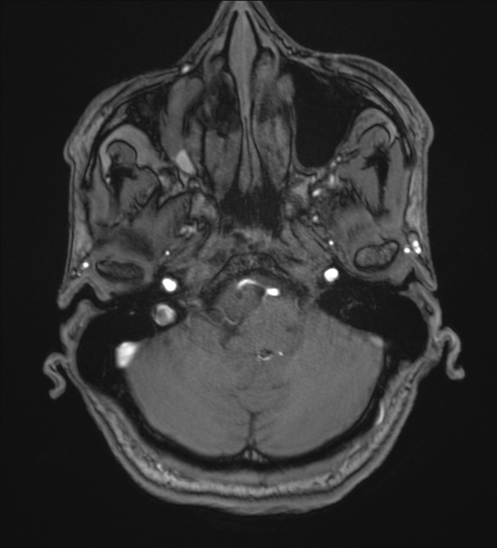 Cerebellopontine angle meningioma (Radiopaedia 72983-83680 Axial MRA 16).jpg