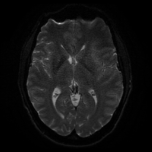 Cerebral abscess (Radiopaedia 57774-64740 Axial DWI 43).png
