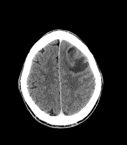 Cerebral abscess (Radiopaedia 57774-64741 Axial C+ delayed 50).png