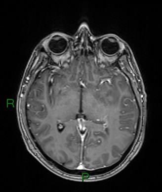 File:Cerebral abscess and subdural empyema (Radiopaedia 84436-99779 Axial T1 C+ 47).jpg