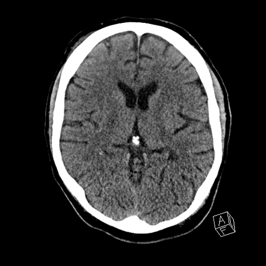 Cerebral abscess with ventriculitis (Radiopaedia 78965-91876 Axial non-contrast 26).jpg