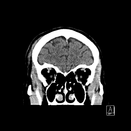 File:Cerebral abscess with ventriculitis (Radiopaedia 78965-91877 B 12).jpg