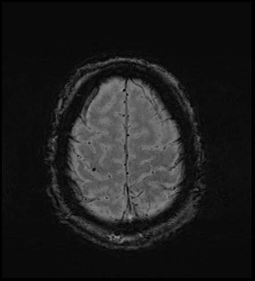 Cerebral abscess with ventriculitis (Radiopaedia 78965-91878 Axial SWI 45).jpg