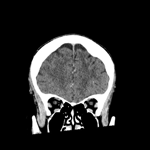 Cerebral amyloid angiopathy-related inflammation (Radiopaedia 74836-85848 Coronal non-contrast 20).jpg