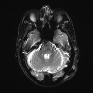Cerebral amyloid angiopathy-related inflammation (Radiopaedia 74836-85849 Axial DWI 9).jpg