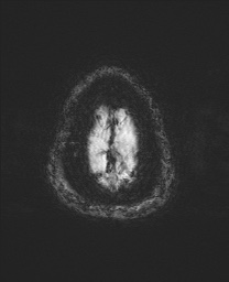 File:Cerebral amyloid angiopathy-related inflammation (Radiopaedia 74836-85849 Axial SWI 69).jpg