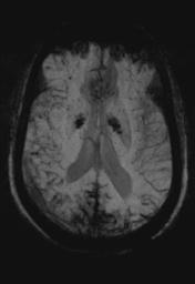 File:Cerebral amyloid angiopathy (Radiopaedia 29129-29518 Axial SWI MIP 18).jpg