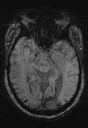 File:Cerebral amyloid angiopathy (Radiopaedia 29129-29518 Axial SWI MPR 15).jpg