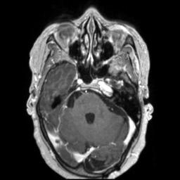 File:Cerebral amyloid angiopathy (Radiopaedia 29129-29518 Axial T1 C+ 45).jpg