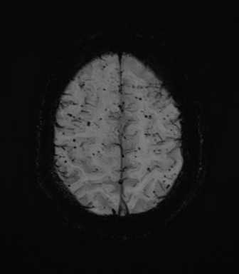 File:Cerebral amyloid angiopathy (Radiopaedia 46082-50433 Axial SWI MIP 64).png