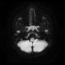 File:Cerebral and spinal tuberculosis (Radiopaedia 90489-107837 Axial DWI 5).jpg