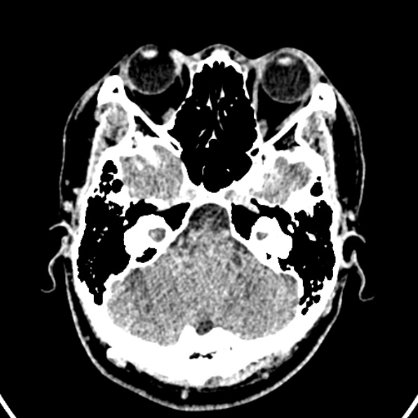 Cerebral arteriovenous malformation (Radiopaedia 37182-39012 Axial non-contrast 9).jpg