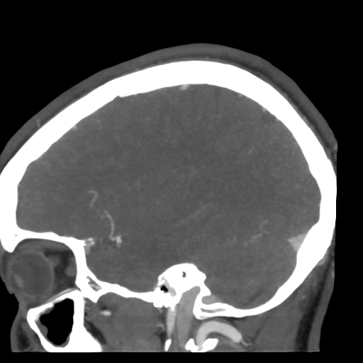 Cerebral arteriovenous malformation (Radiopaedia 39259-41505 Sagittal 44).png