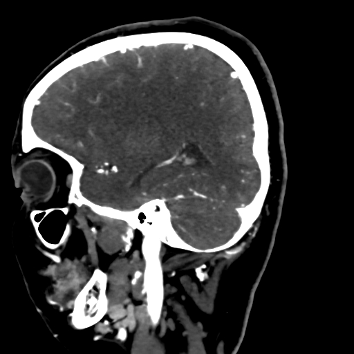 Cerebral arteriovenous malformation (Radiopaedia 73830-84645 Sagittal C+ delayed 26).jpg