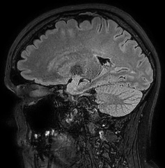 Cerebral arteriovenous malformation (Radiopaedia 74411-85654 Sagittal FLAIR 44).jpg