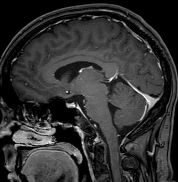 Cerebral arteriovenous malformation (Radiopaedia 74411-85746 Sagittal T1 C+ 60).jpg