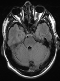 File:Cerebral arteriovenous malformation - huge (Radiopaedia 35734-37272 Axial FLAIR 7).png