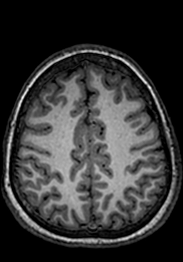 File:Cerebral arteriovenous malformation at posterior body of corpus callosum (Radiopaedia 74111-84925 Axial T1 69).jpg