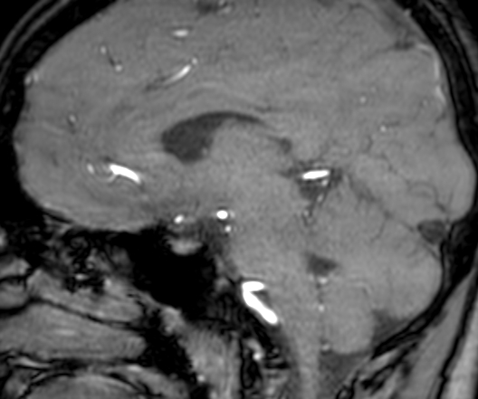 Cerebral arteriovenous malformation at posterior body of corpus callosum (Radiopaedia 74111-84925 J 211).jpg