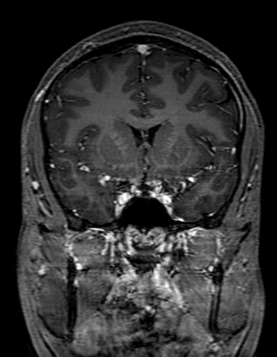 Cerebral arteriovenous malformation at posterior body of corpus callosum (Radiopaedia 74111-84925 K 135).jpg