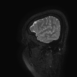 Cerebral arteriovenous malformation at posterior body of corpus callosum (Radiopaedia 74111-84925 Sagittal T2 128).jpg