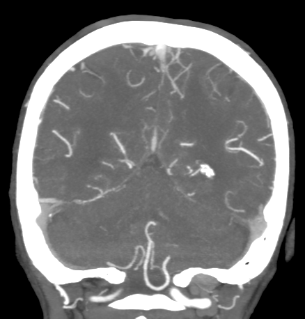 Cerebral arteriovenous malformation with lobar hemorrhage (Radiopaedia 44725-48511 B 42).png