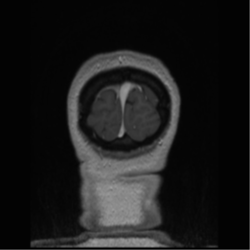 Cerebral cavernoma and development venous anomaly (Radiopaedia 37603-39482 Coronal T1 C+ 6).png
