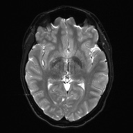 File:Cerebral cavernous venous malformation (Radiopaedia 70008-80021 Axial DWI 15).jpg