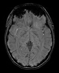 Cerebral cavernous venous malformation (Radiopaedia 70008-80021 I 34).jpg