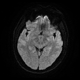 Cerebral cavernous venous malformation (Zabramski type II) (Radiopaedia 85511-101198 Axial DWI 15).jpg