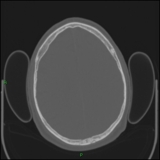 Cerebral contusions (Radiopaedia 33868-35039 Axial bone window 148).jpg