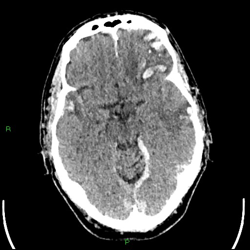 File:Cerebral contusions (Radiopaedia 33868-35039 Axial non-contrast 81).jpg