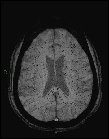 Cerebral fat embolism (Radiopaedia 35022-36525 Axial SWI 30).jpg