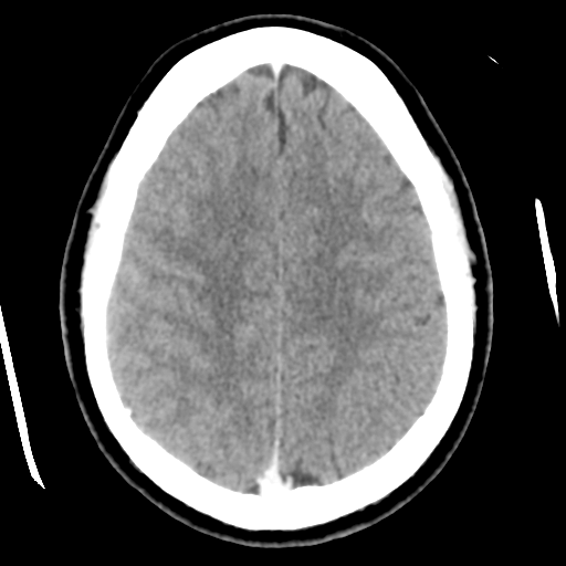 File:Cerebral hemorrhage secondary to arteriovenous malformation (Radiopaedia 33497-34561 B 40).png