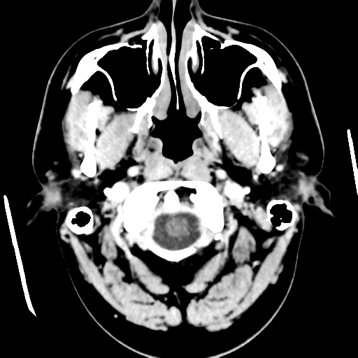 Cerebral hemorrhage secondary to arteriovenous malformation (Radiopaedia 33497-34561 B 5).png