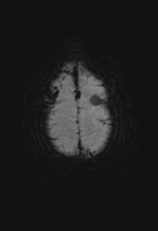 File:Cerebral hemorrhagic contusions- temporal evolution (Radiopaedia 40224-42757 Axial SWI 30).png