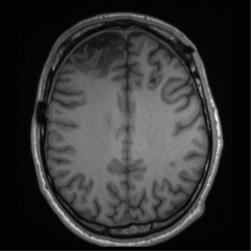 Cerebral hemorrhagic contusions- temporal evolution (Radiopaedia 40224-42757 Axial T1 52).png