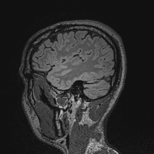 File:Cerebral hemorrhagic contusions- temporal evolution (Radiopaedia 40224-42757 Sagittal T1 18).png