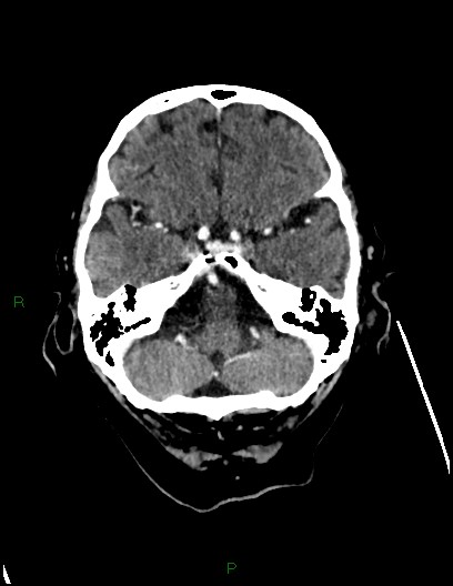 Cerebral metastases - ependymal and parenchymal (Radiopaedia 79877-93131 Axial C+ delayed 18).jpg