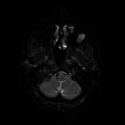 Cerebral metastases - melanoma (Radiopaedia 80972-94522 Axial DWI 69).jpg