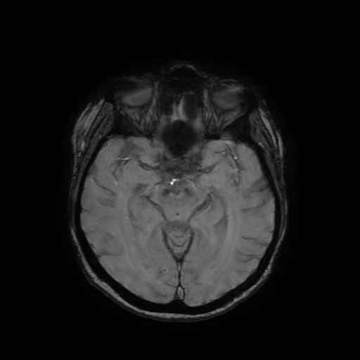 Cerebral metastases - melanoma (Radiopaedia 80972-94522 Axial SWI 43).jpg