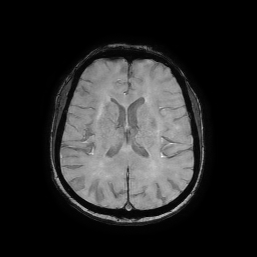Cerebral metastases - melanoma (Radiopaedia 80972-94522 Axial SWI 59).jpg
