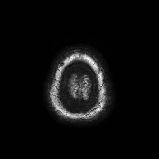 Cerebral metastases - melanoma (Radiopaedia 80972-94522 Axial SWI 98).jpg